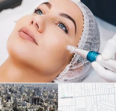 مزونیدلینگ در جیحون