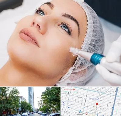 مزونیدلینگ در امامت مشهد