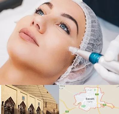 مزونیدلینگ در ساوه