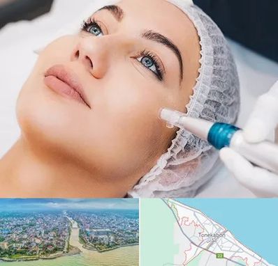 مزونیدلینگ در تنکابن