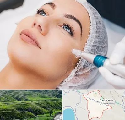 مزونیدلینگ در گچساران