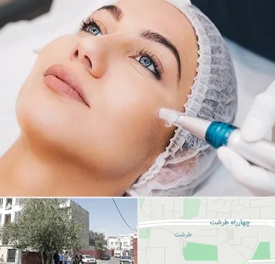مزونیدلینگ در طرشت