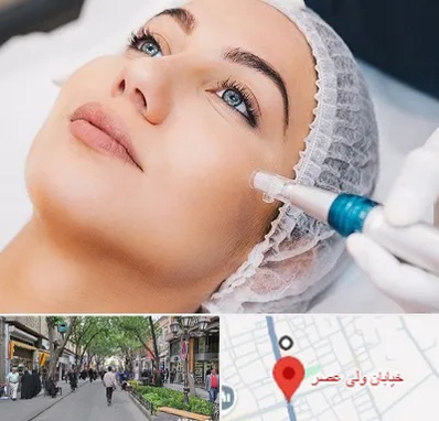 مزونیدلینگ در ولیعصر شهریار