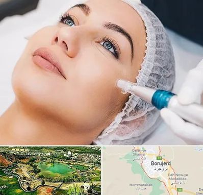 مزونیدلینگ در بروجرد