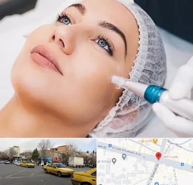 مزونیدلینگ در شهناز تبریز