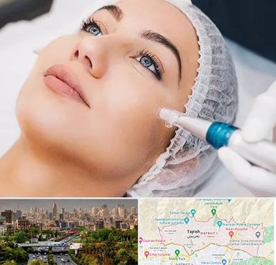 مزونیدلینگ در منطقه 1 تهران 