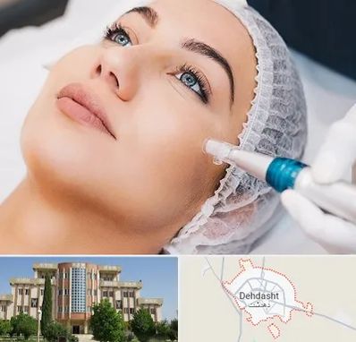 مزونیدلینگ در دهدشت