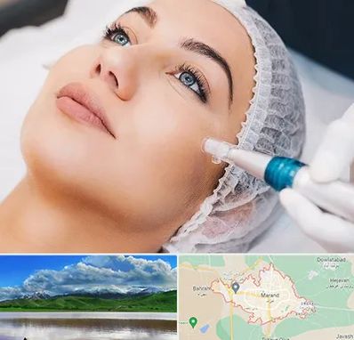 مزونیدلینگ در مرند