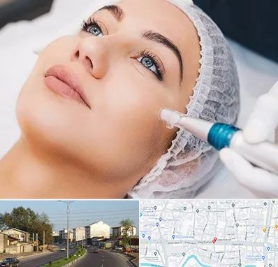 مزونیدلینگ در ضیابری رشت