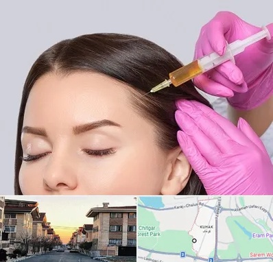 تزریق هیر فیلر در کوهک