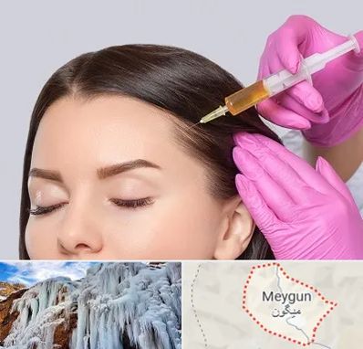 تزریق هیر فیلر در میگون