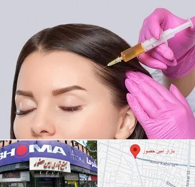 تزریق هیر فیلر در امین حضور