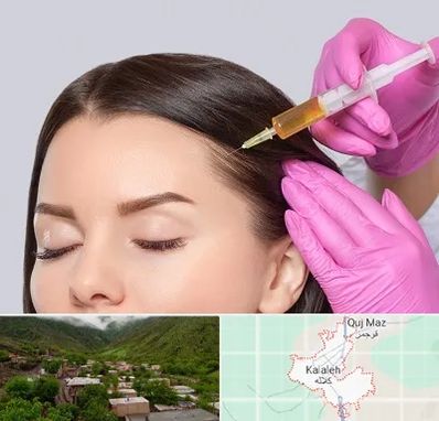 تزریق هیر فیلر در کلاله