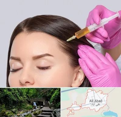 تزریق هیر فیلر در علی‌ آباد کتول