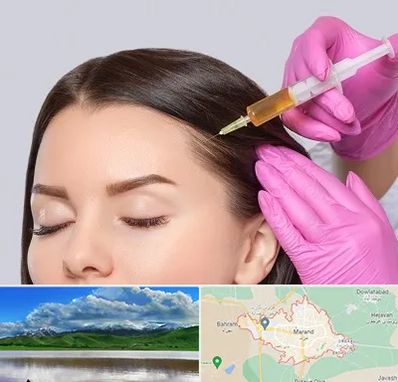 تزریق هیر فیلر در مرند