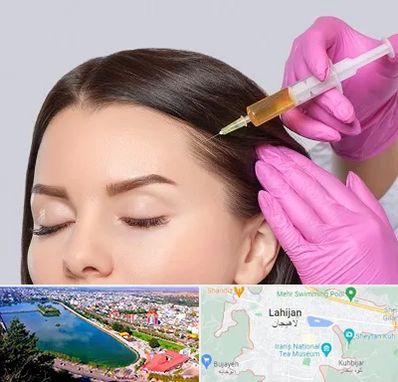 تزریق هیر فیلر در لاهیجان