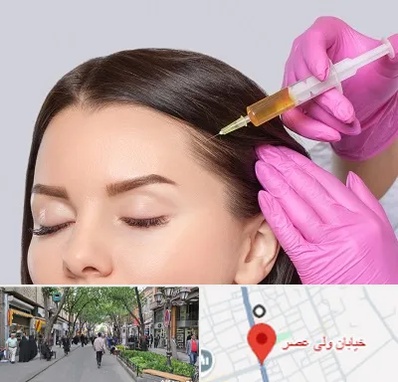 تزریق هیر فیلر در ولیعصر شهریار