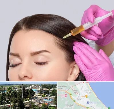 تزریق هیر فیلر در رودسر