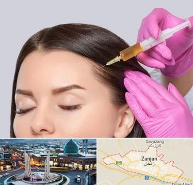 تزریق هیر فیلر در زنجان