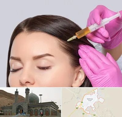 تزریق هیر فیلر در شهرضا