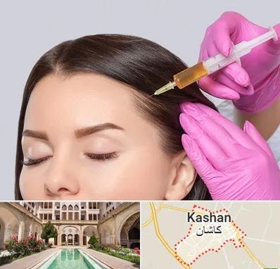 تزریق هیر فیلر در کاشان