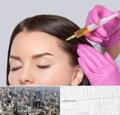 تزریق هیر فیلر در جیحون