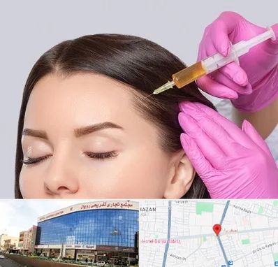 تزریق هیر فیلر در نصف راه تبریز