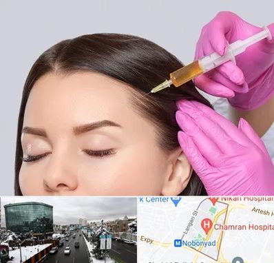 تزریق هیر فیلر در اقدسیه 