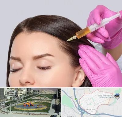 تزریق هیر فیلر در مرزداران تبریز