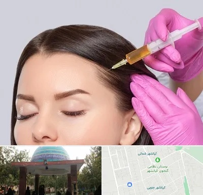 تزریق هیر فیلر در کیانشهر