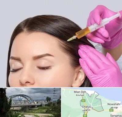 تزریق هیر فیلر در چالوس
