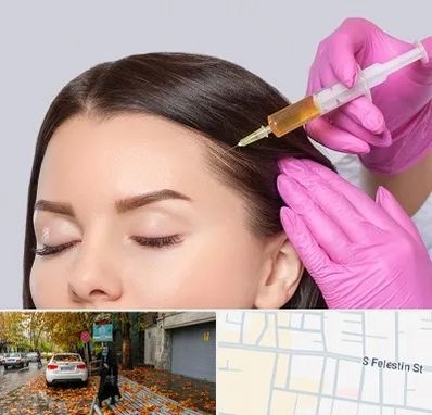 تزریق هیر فیلر در خیابان فلسطین