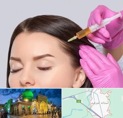 تزریق هیر فیلر در آستانه اشرفیه
