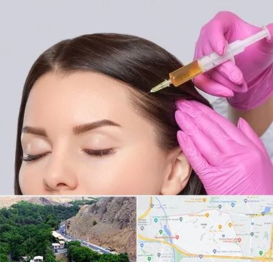 تزریق هیر فیلر در کن 