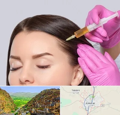 تزریق هیر فیلر در کامیاران