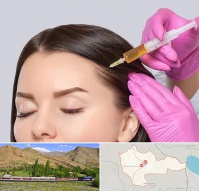 تزریق هیر فیلر در خاش