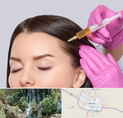 تزریق هیر فیلر در شیروان