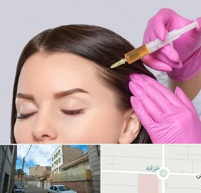 تزریق هیر فیلر در خزانه