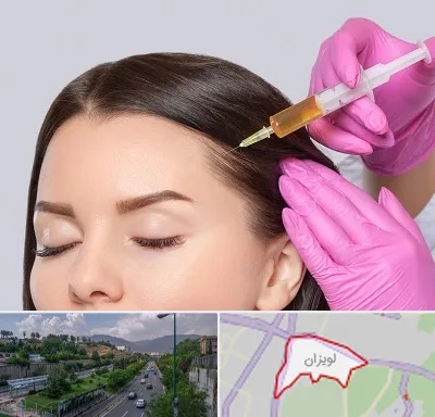 تزریق هیر فیلر در لویزان