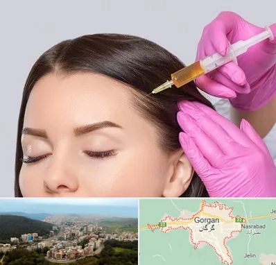 تزریق هیر فیلر در گرگان