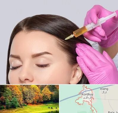 تزریق هیر فیلر در کردکوی