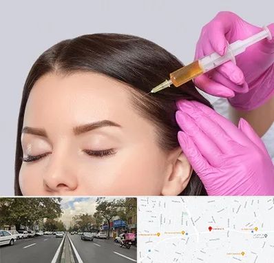 تزریق هیر فیلر در دولت