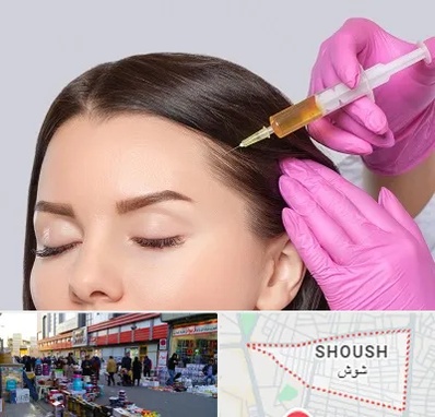 تزریق هیر فیلر در شوش