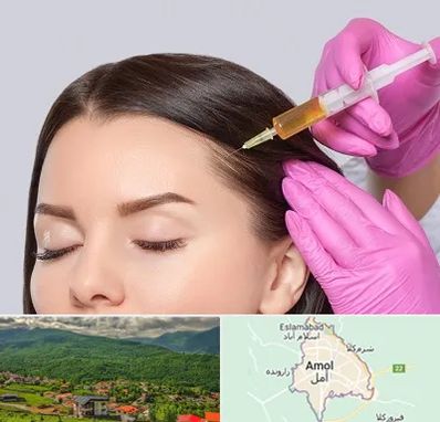 تزریق هیر فیلر در آمل