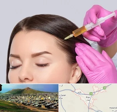 تزریق هیر فیلر در بیجار