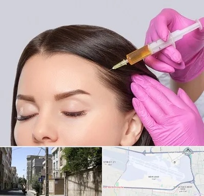 تزریق هیر فیلر در مهرآباد