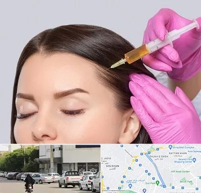 تزریق هیر فیلر در قدوسی شرقی شیراز