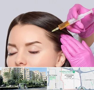 تزریق هیر فیلر در آپادانا