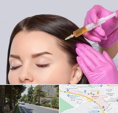 تزریق هیر فیلر در مهرویلا کرج