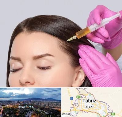 تزریق هیر فیلر در تبریز